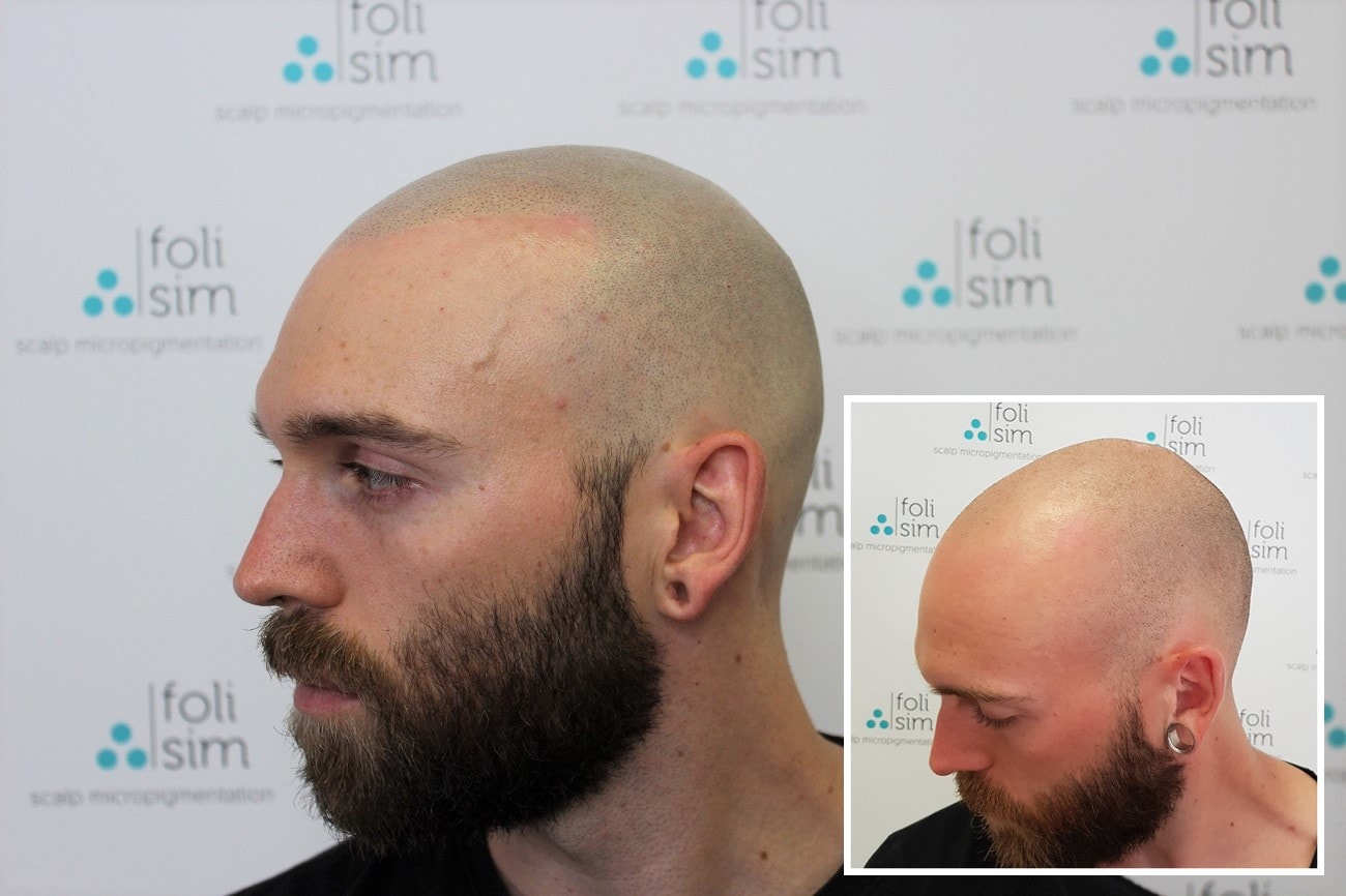 Grow Your Hair with Scalp Micropigmentation post thumbnail image