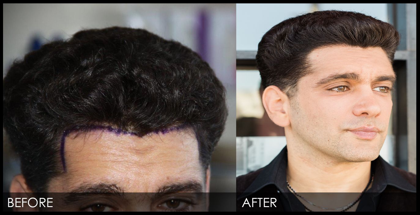 Side-Effects Of Mens Hair Transplant California! post thumbnail image
